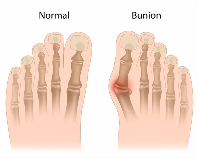 Bunion diagram
