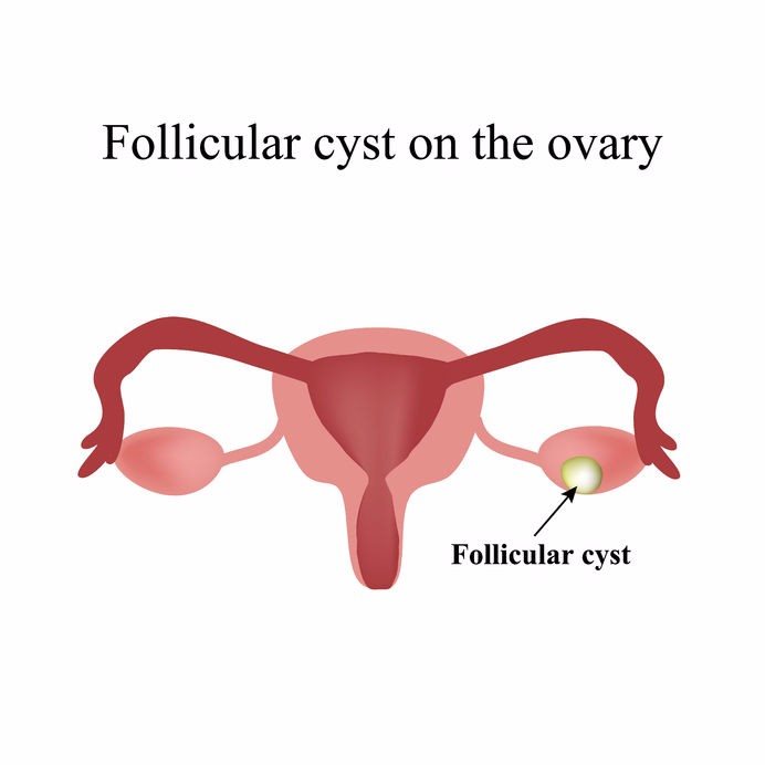 Illustration showing a follicular cyst on an ovary