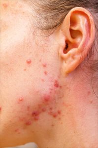Young woman with acne prone skin