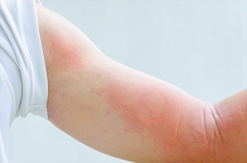 Scarlet Fever: Signs, Symptoms, and Complicatons