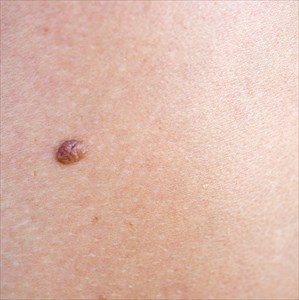 Close-up of a mole on human skin.