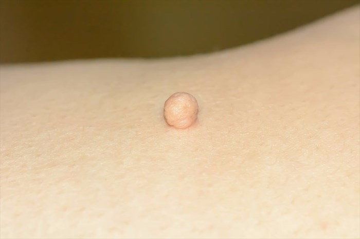 Skin tag or acrochondon on the surface of the skin.