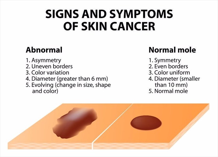 Illustration showing the essential rules for detecting skin cancer.
