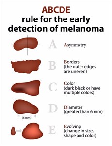 Signs to look out for to detect melanoma (skin cancer).