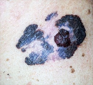 Malignant melanoma (skin cancer).