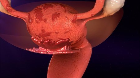 Endometriosis