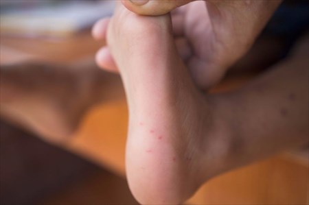 Hand, Foot and Mouth Disease