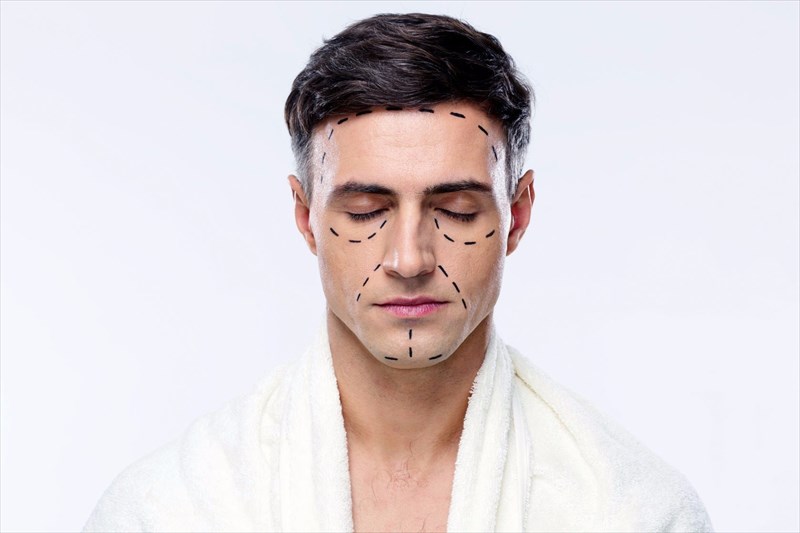 Face-lift (Rhytidectomy)