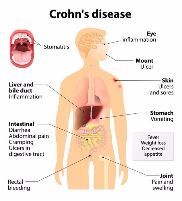 Crohn's symptoms