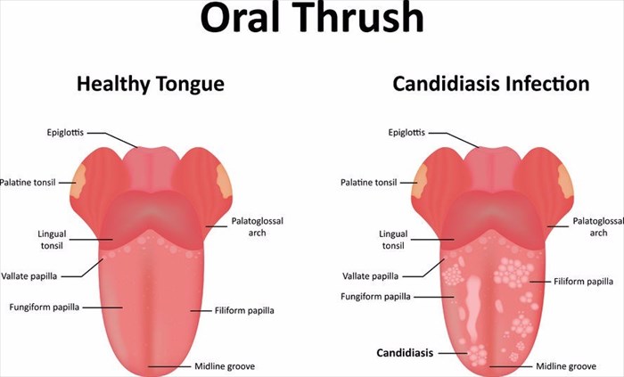 Oropharyngeal oesophageal candidiasis also known as oral thrush